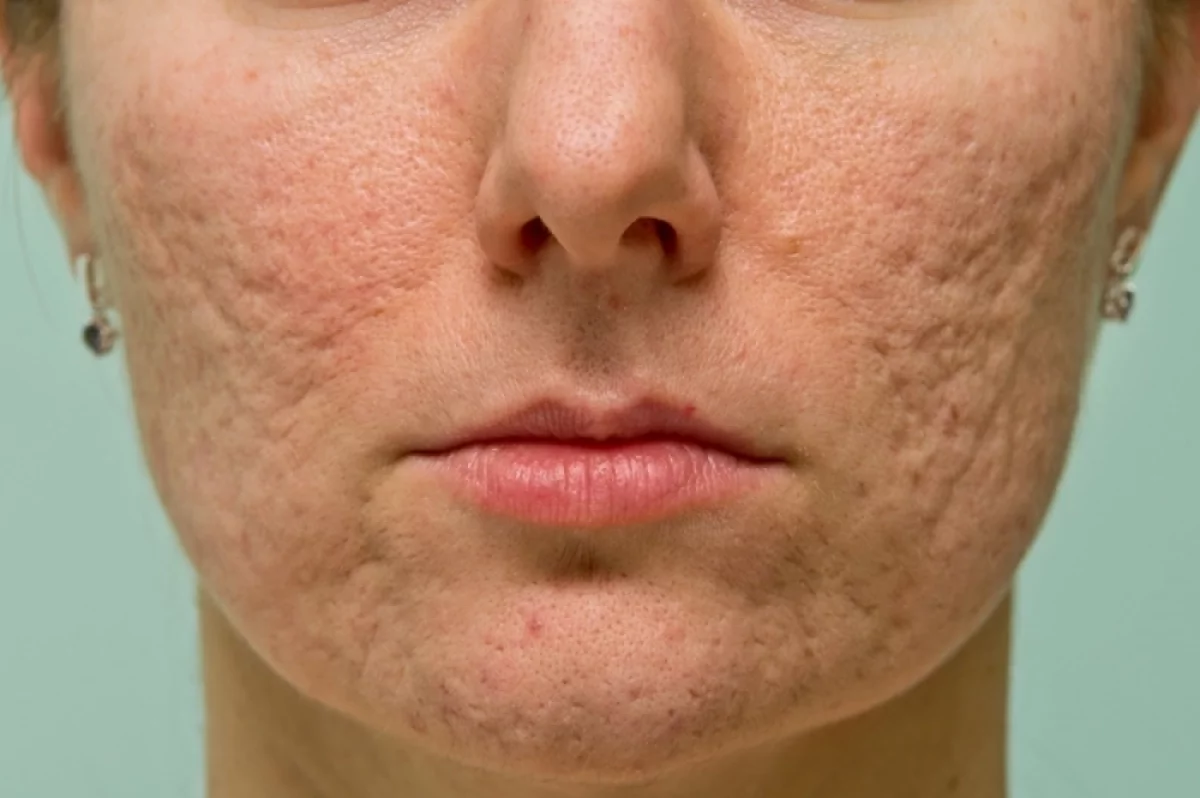 Серая косметология в России: риски, последствия и как защитить здоровье