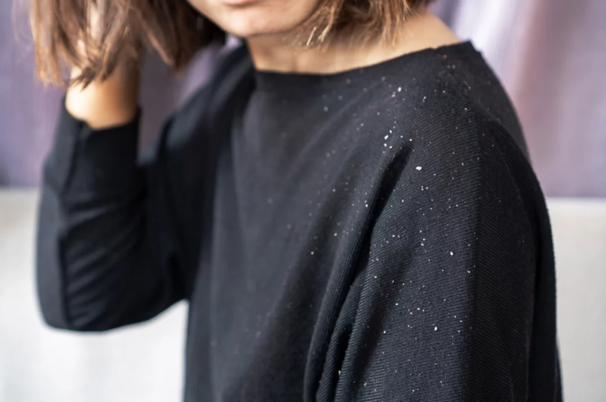 Перхоть и выпадение волос: необычная связь, причины и как остановить облысение