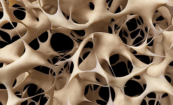 Остеопороз