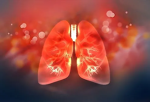 Эмфизема легких