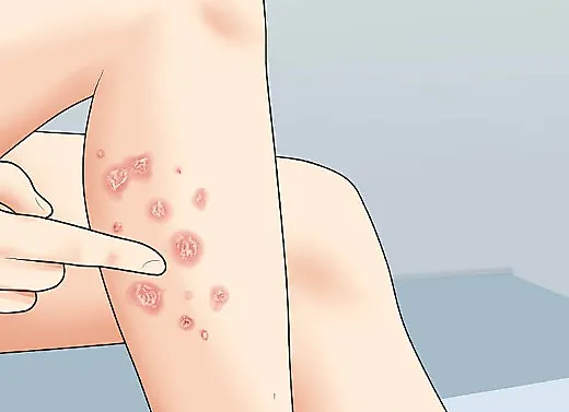 Псориаз (чешуйчатый лишай)