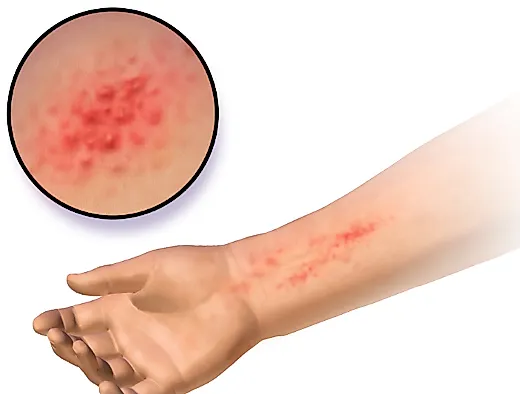 Аллергический дерматит (крапивница)