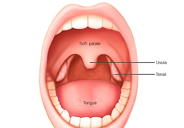 Ангина (тонзиллит острый)