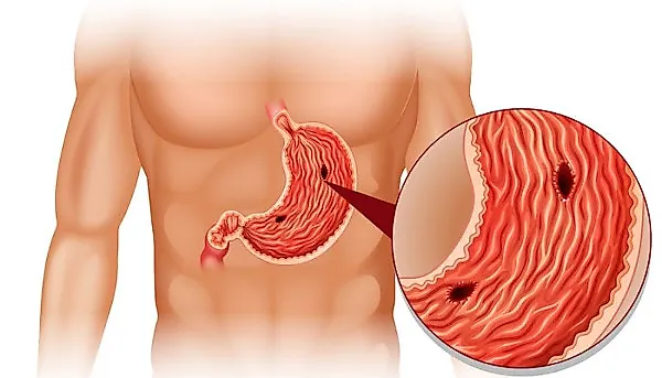 Язвенная болезнь