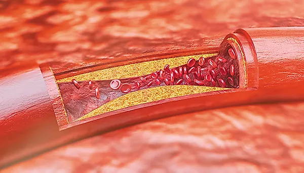 Атеросклероз