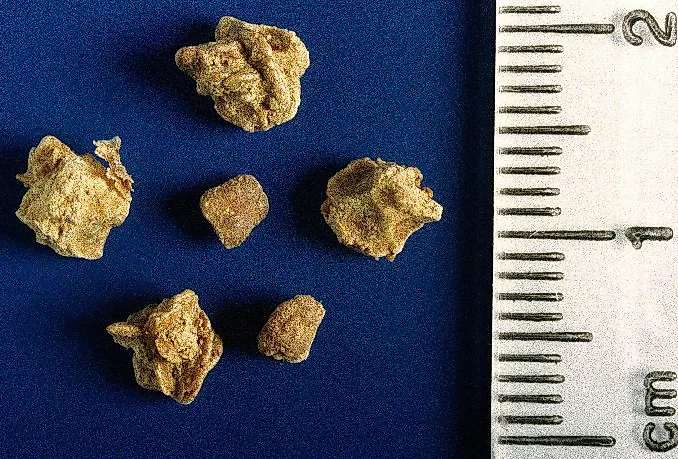 Мочекаменная болезнь