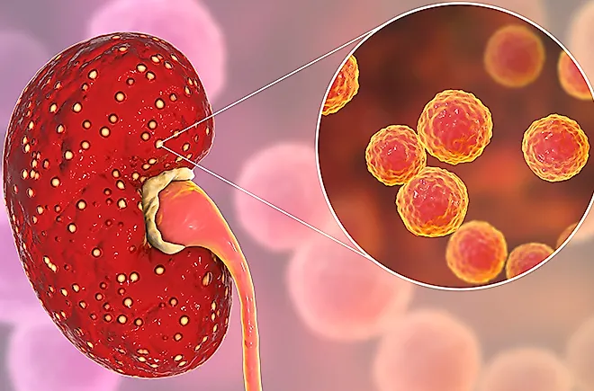 Пиелонефрит и гломерулонефрит