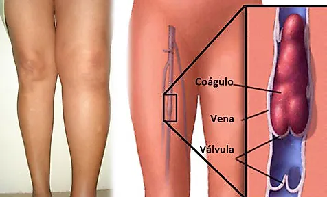 Тромбофлебит