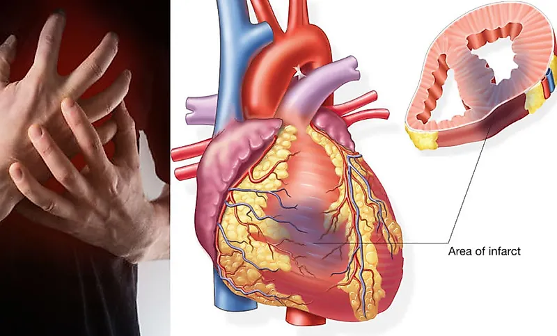 Инфаркт миокарда