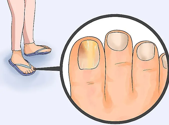 Грибковые заболевания кожи